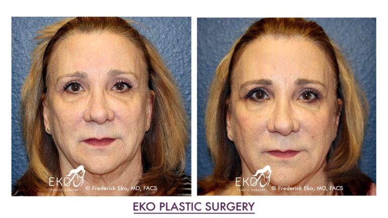 Botox Before and After Photo by Dr. Eko of Eko Plastic Surgery in Palm Desert, CA Botox Before and After Photo by Dr. Eko of Eko Plastic Surgery in Palm Desert, CA
