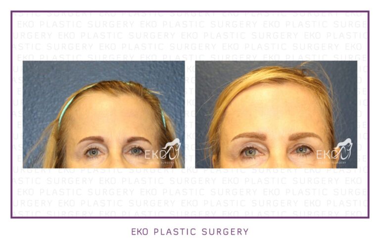 Botox Before and After Photo by Dr. Eko of Eko Plastic Surgery in Palm Desert, CA Botox Before and After Photo by Dr. Eko of Eko Plastic Surgery in Palm Desert, CA