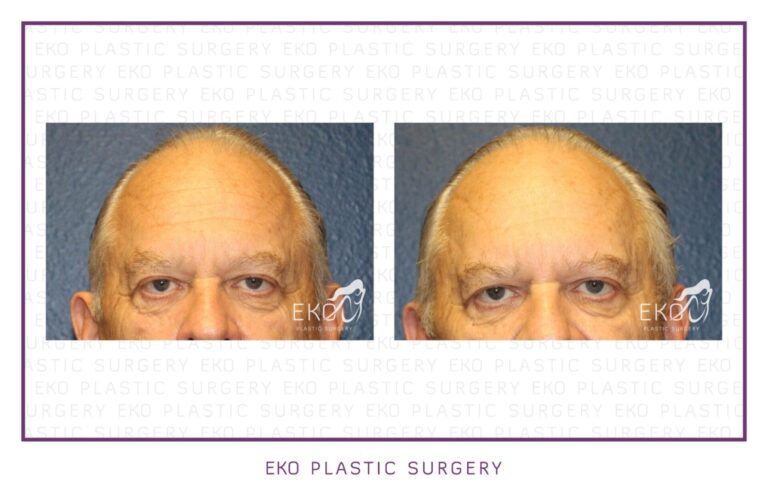 Botox Before and After Photo by Dr. Eko of Eko Plastic Surgery in Palm Desert, CA Botox Before and After Photo by Dr. Eko of Eko Plastic Surgery in Palm Desert, CA
