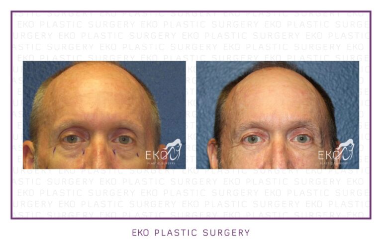 Botox Before and After Photo by Dr. Eko of Eko Plastic Surgery in Palm Desert, CA Botox Before and After Photo by Dr. Eko of Eko Plastic Surgery in Palm Desert, CA
