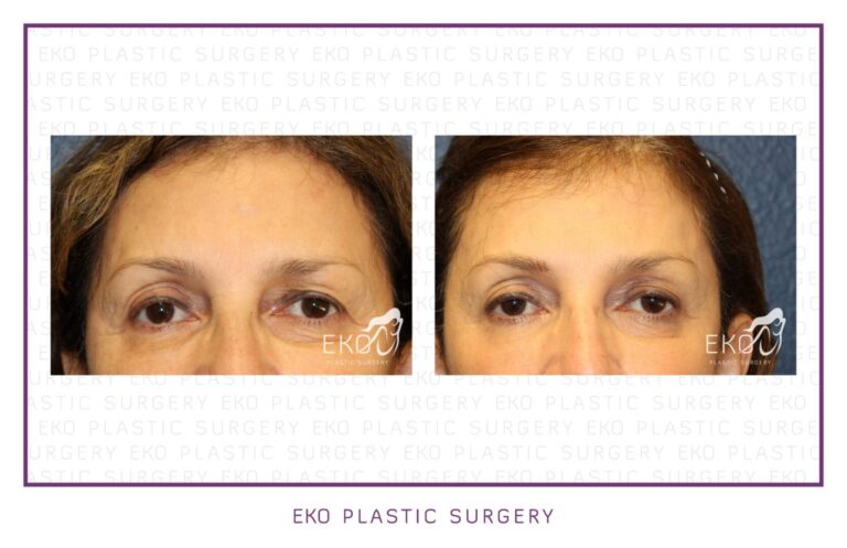 Botox Before and After Photo by Dr. Eko of Eko Plastic Surgery in Palm Desert, CA Botox Before and After Photo by Dr. Eko of Eko Plastic Surgery in Palm Desert, CA