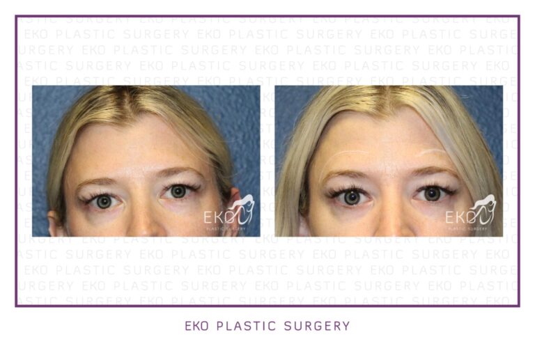 Botox Before and After Photo by Dr. Eko of Eko Plastic Surgery in Palm Desert, CA Botox Before and After Photo by Dr. Eko of Eko Plastic Surgery in Palm Desert, CA