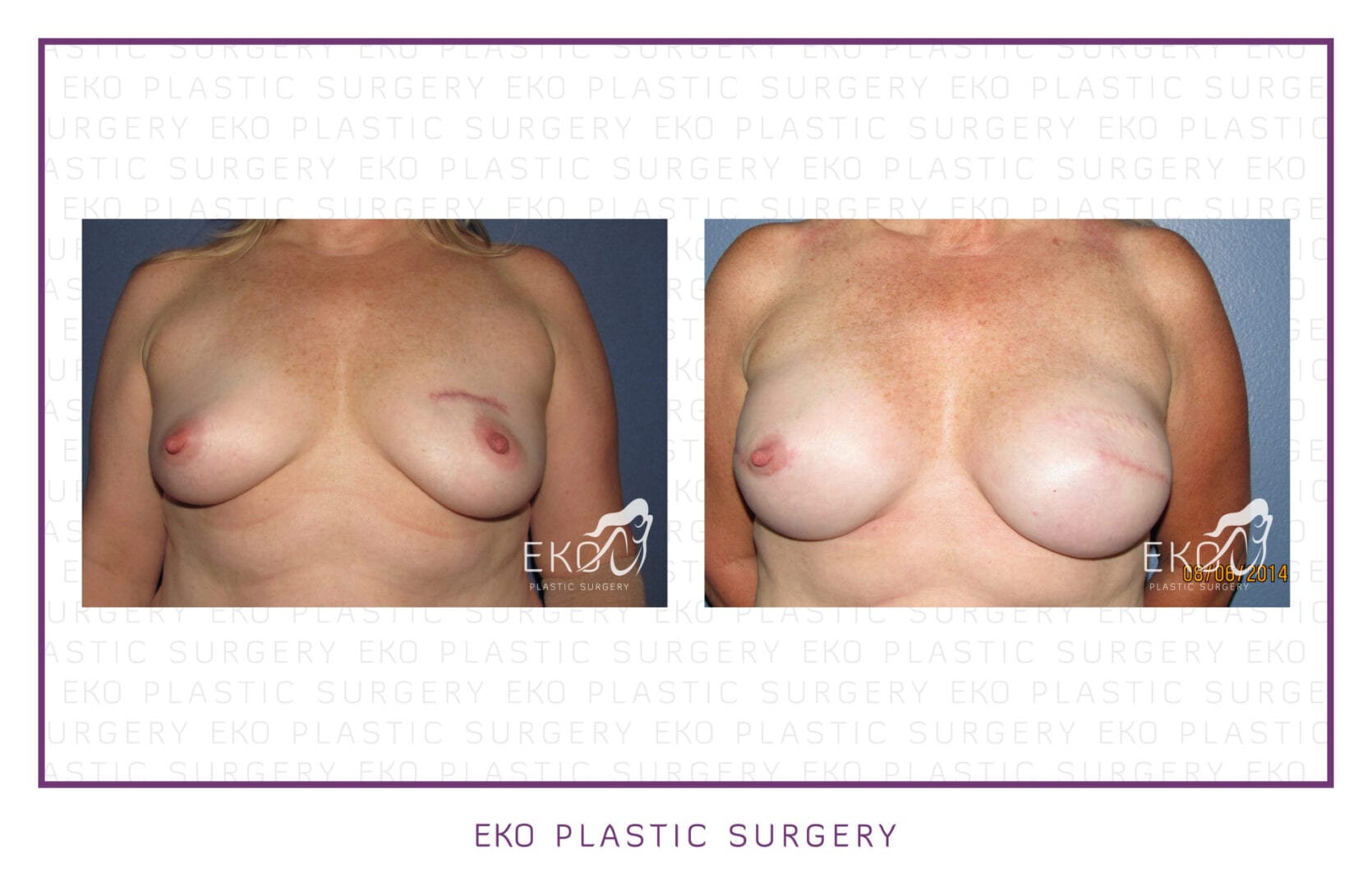 Breast Reconstruction Before and After Photo by Dr. Eko of Eko Plastic Surgery in Palm Desert, CA