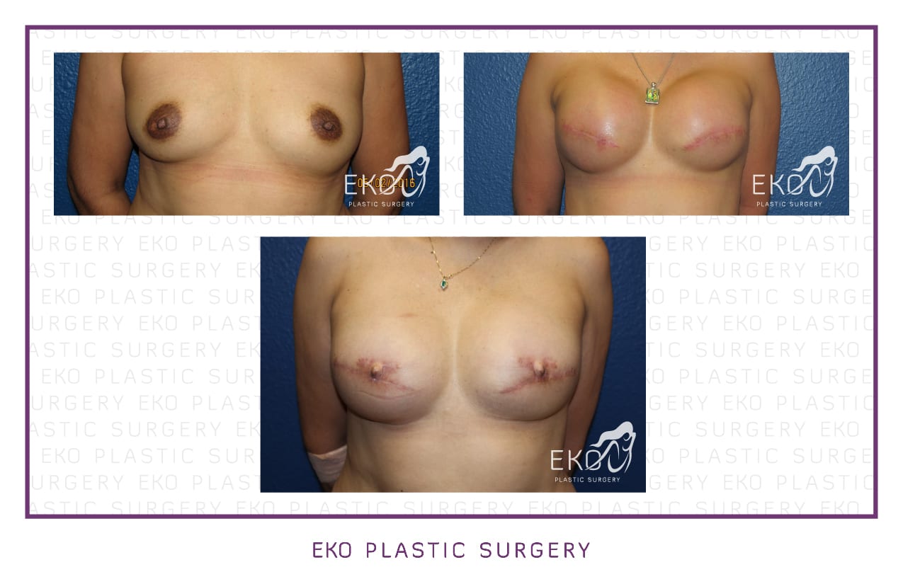 Breast Reconstruction Before and After Photo by Dr. Eko of Eko Plastic Surgery in Palm Desert, CA