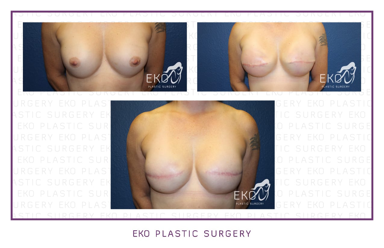 Breast Reconstruction Before and After Photo by Dr. Eko of Eko Plastic Surgery in Palm Desert, CA