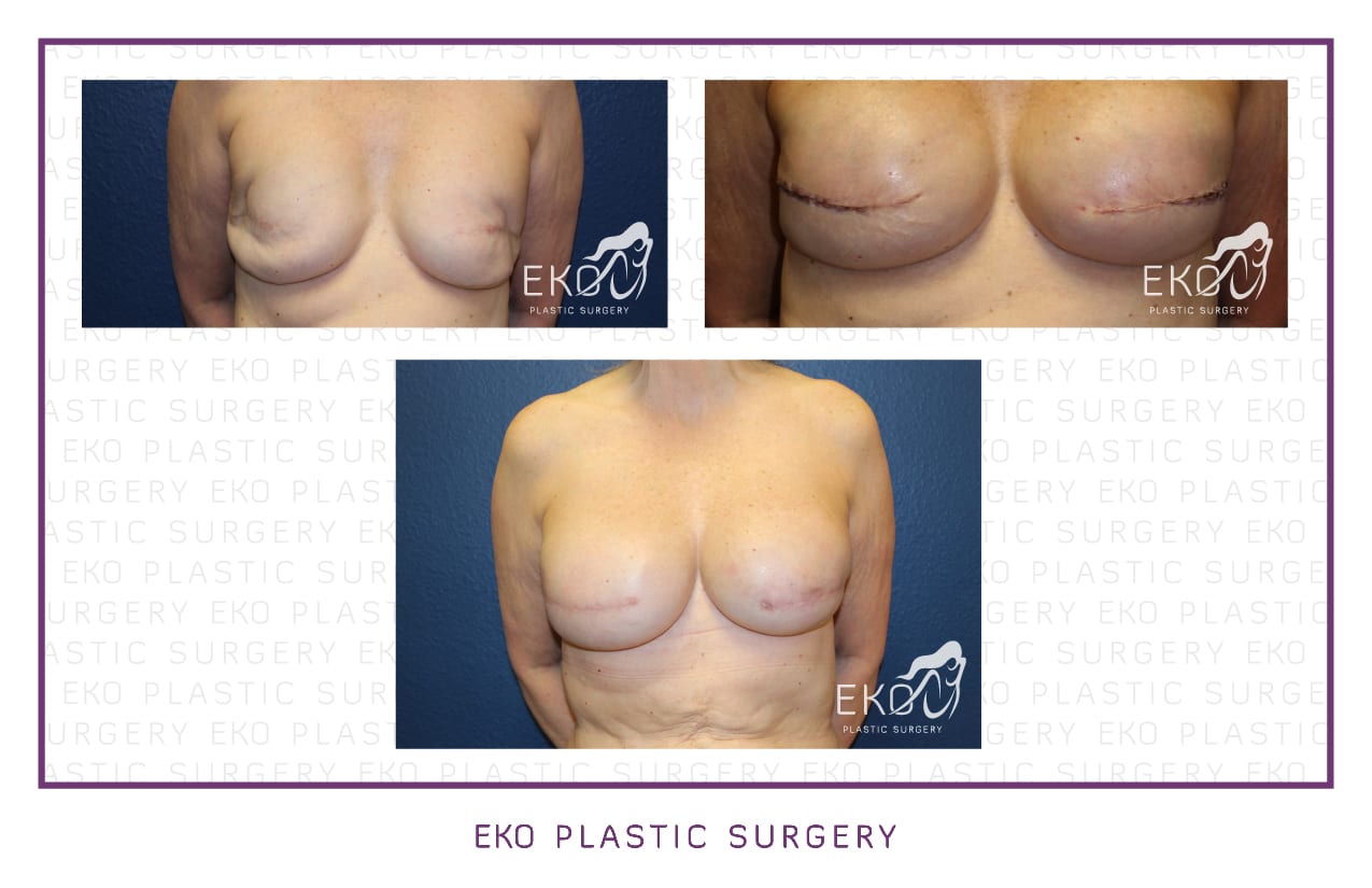 Breast Reconstruction Before and After Photo by Dr. Eko of Eko Plastic Surgery in Palm Desert, CA