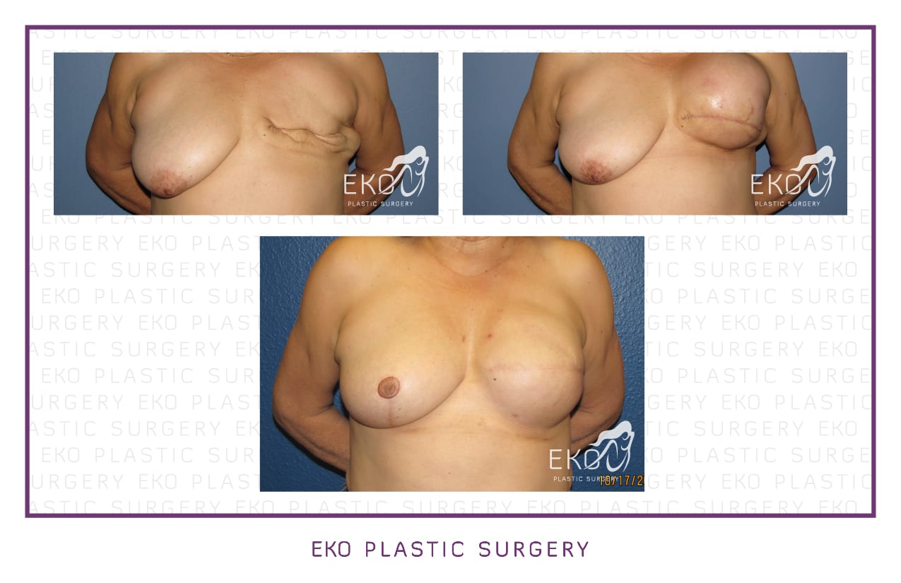 Breast Reconstruction Before and After Photo by Dr. Eko of Eko Plastic Surgery in Palm Desert, CA