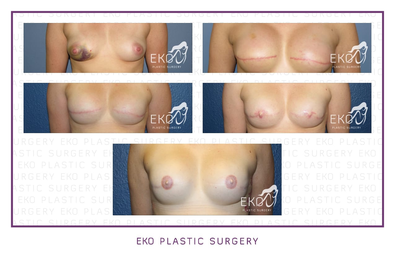 Breast Reconstruction Before and After Photo by Dr. Eko of Eko Plastic Surgery in Palm Desert, CA
