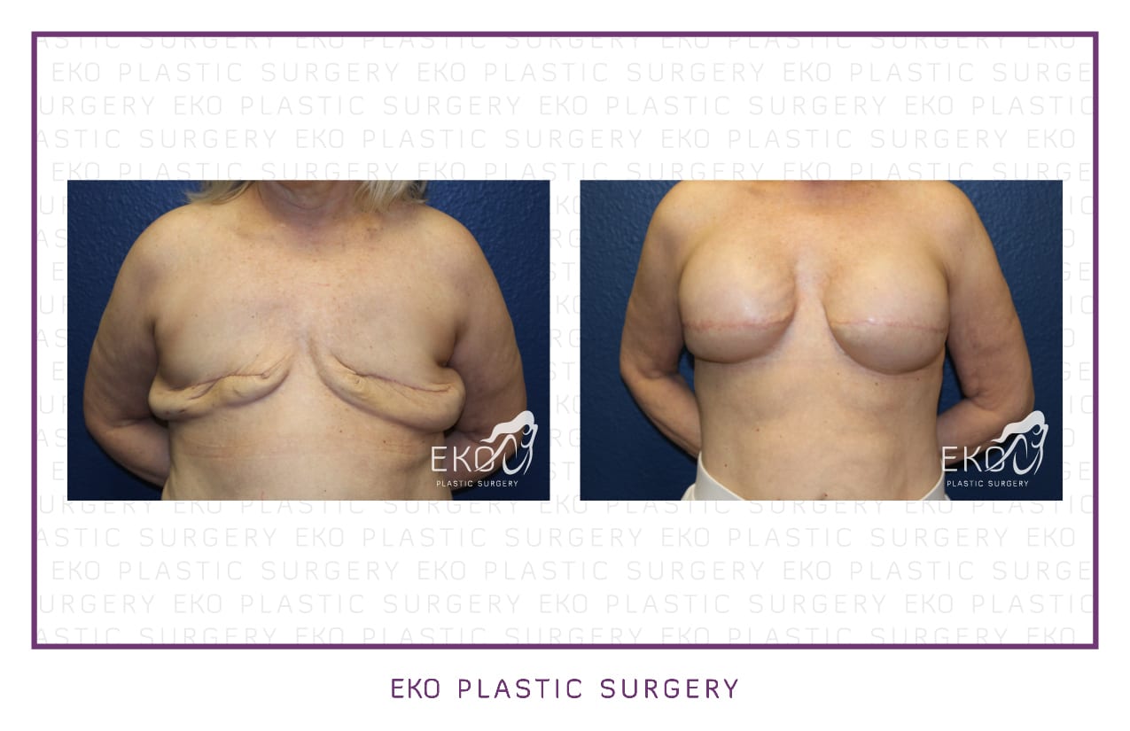 Breast Reconstruction Before and After Photo by Dr. Eko of Eko Plastic Surgery in Palm Desert, CA