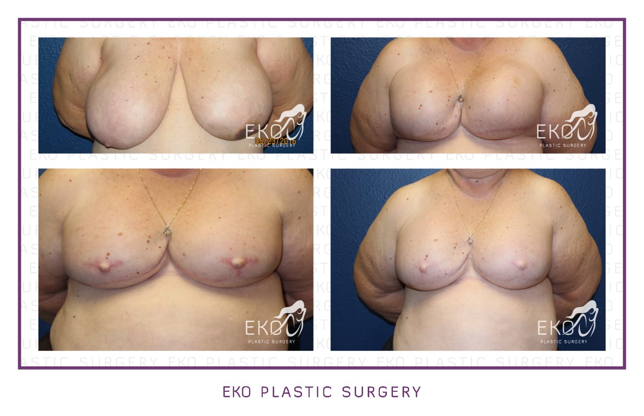 Breast Reconstruction Before and After Photo by Dr. Eko of Eko Plastic Surgery in Palm Desert, CA