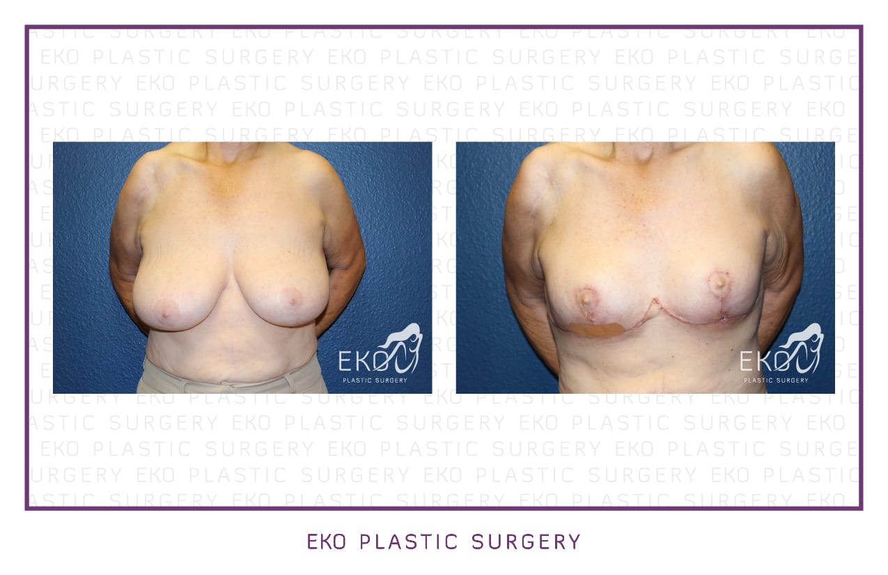 Breast Reduction Before and After Photo by Dr. Eko of Eko Plastic Surgery in Palm Desert, CA