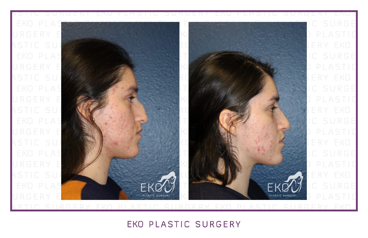 Rhinoplasty Before and After Photo by Dr. Eko of Eko Plastic Surgery in Palm Desert, CA