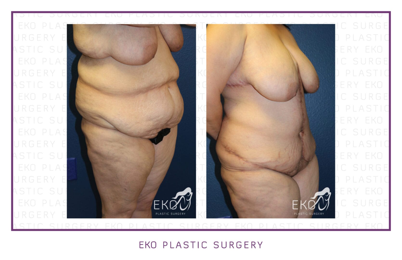 Post-Weight-Loss Procedures Before and After Photo by Dr. Eko of Eko Plastic Surgery in Palm Desert, CA
