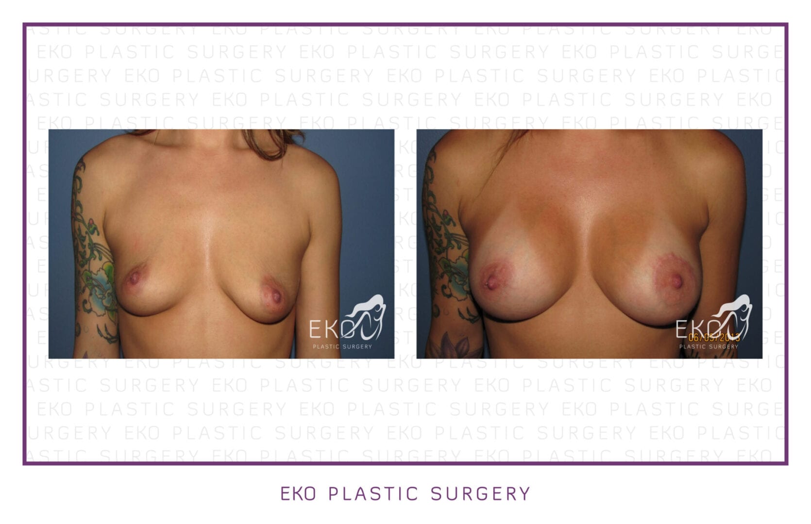 Breast Augmentation Before and After Photo by Dr. Eko of Eko Plastic Surgery in Palm Desert, CA