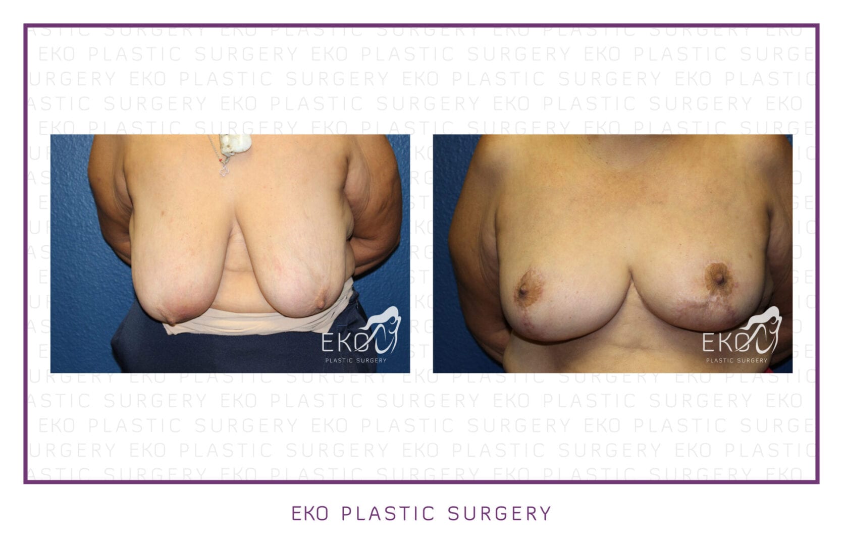 Breast Lift Before and After Photo by Dr. Eko of Eko Plastic Surgery in Palm Desert, CA