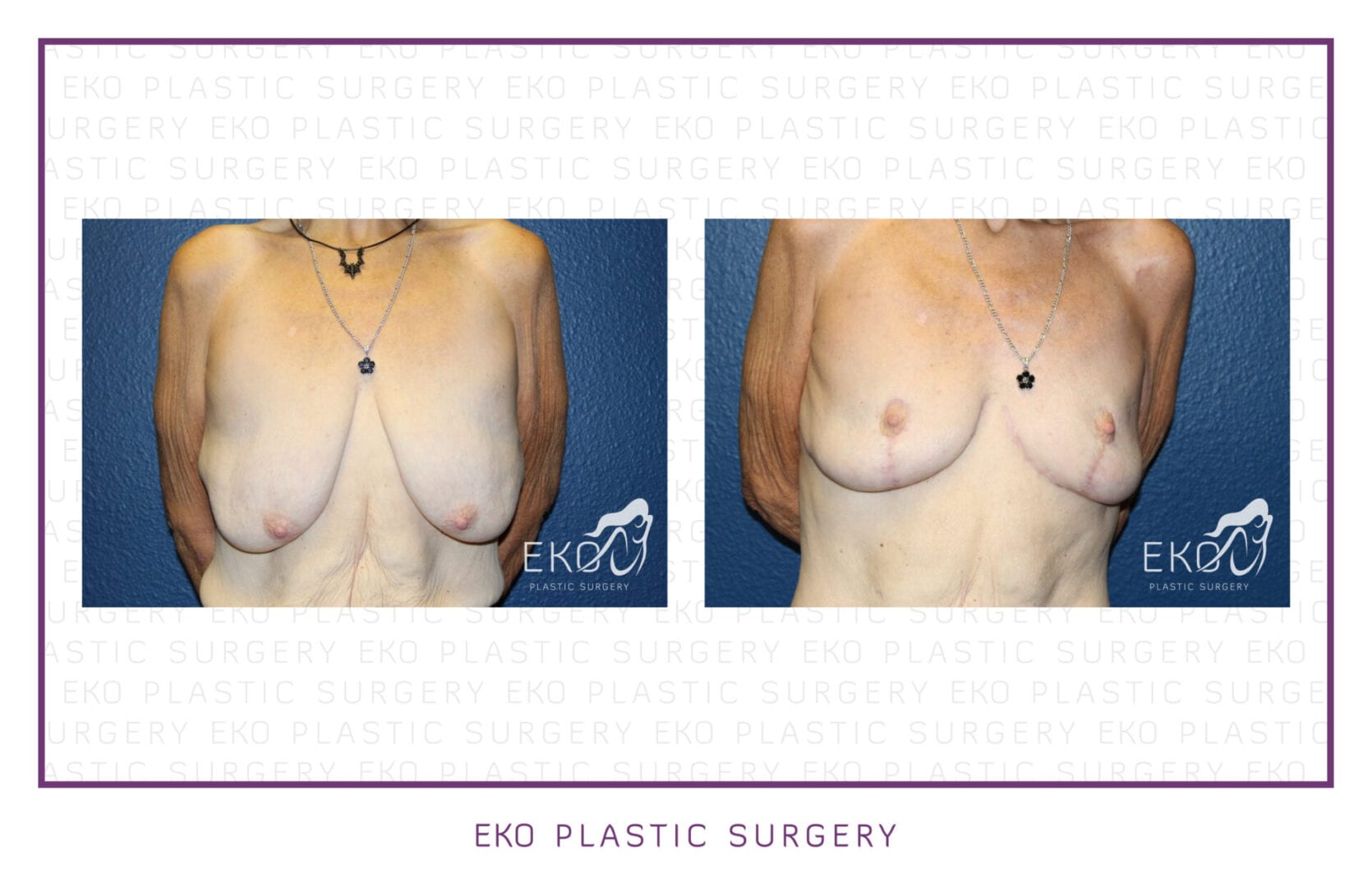 Breast Lift Before and After Photo by Dr. Eko of Eko Plastic Surgery in Palm Desert, CA