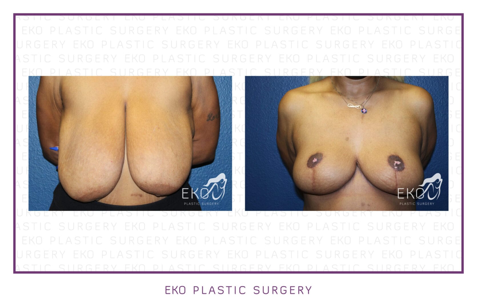 Breast Reduction Before and After Photo by Dr. Eko of Eko Plastic Surgery in Palm Desert, CA