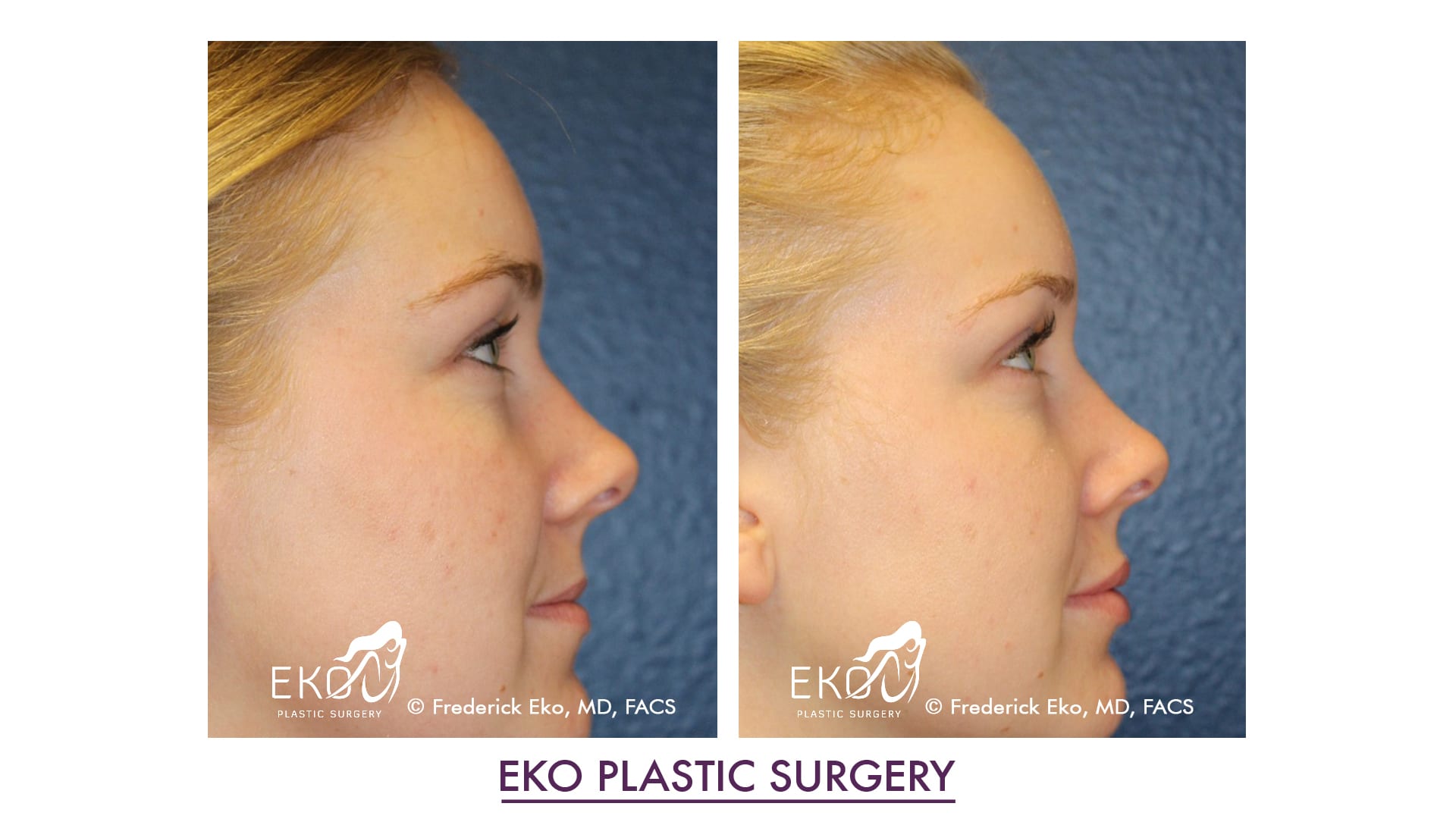 Juvederm Before and After Photo by Dr. Eko of Eko Plastic Surgery in Palm Desert, CA