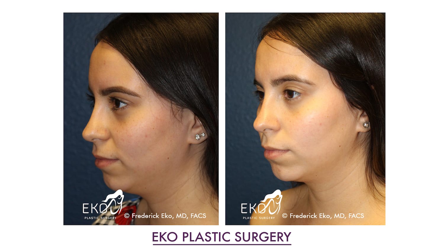 Kybella® Before and After Photo by Dr. Eko of Eko Plastic Surgery in Palm Desert, CA