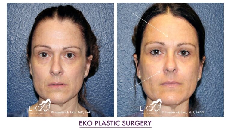 Botox Before and After Photo by Dr. Eko of Eko Plastic Surgery in Palm Desert, CA Botox Before and After Photo by Dr. Eko of Eko Plastic Surgery in Palm Desert, CA