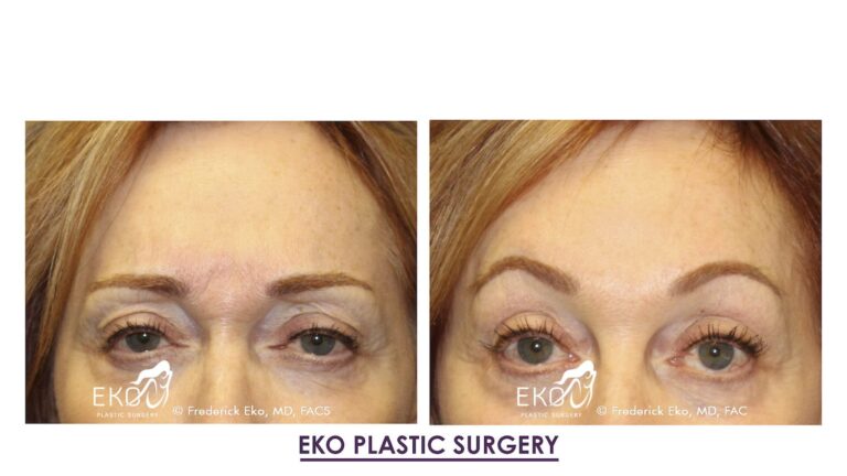 Botox Before and After Photo by Dr. Eko of Eko Plastic Surgery in Palm Desert, CA Botox Before and After Photo by Dr. Eko of Eko Plastic Surgery in Palm Desert, CA