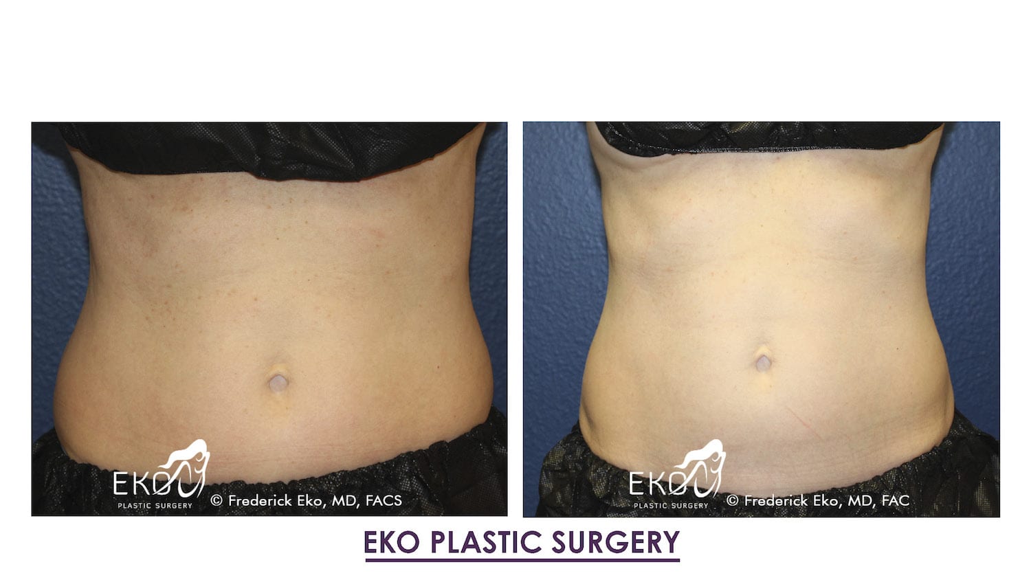 Coolsculpting Before and After Photo by Dr. Eko of Eko Plastic Surgery in Palm Desert, CA