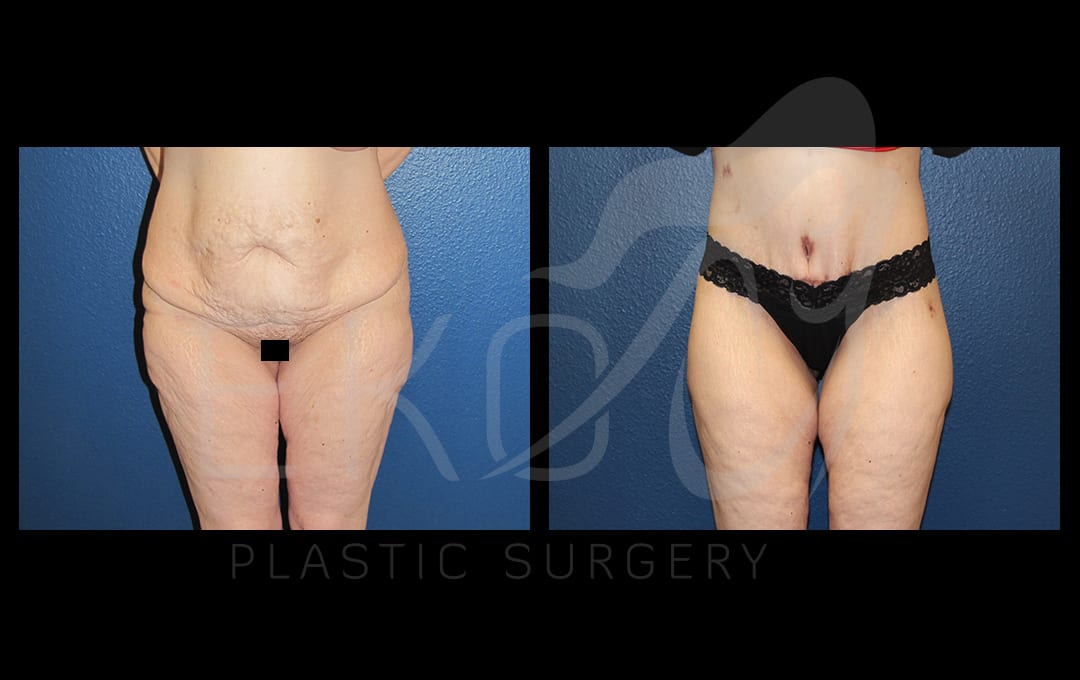 Tummy Tuck (Abdominoplasty) Before and After Photo by Dr. Eko of Eko Plastic Surgery in Palm Desert, CA