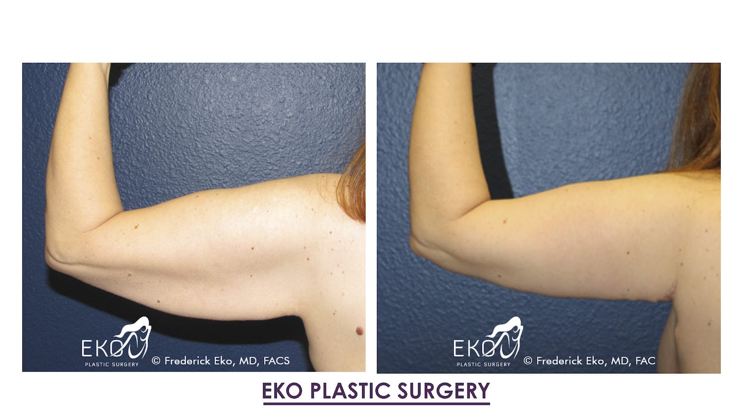 Arm Lift (Brachioplasty) Before and After Photo by Dr. Eko of Eko Plastic Surgery in Palm Desert, CA