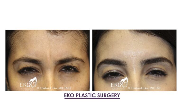 Botox Before and After Photo by Dr. Eko of Eko Plastic Surgery in Palm Desert, CA Botox Before and After Photo by Dr. Eko of Eko Plastic Surgery in Palm Desert, CA