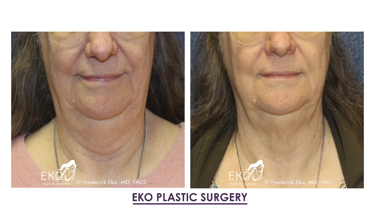 CoolSculpting® Before and After Photo by Dr. Eko of Eko Plastic Surgery in Palm Desert, CA