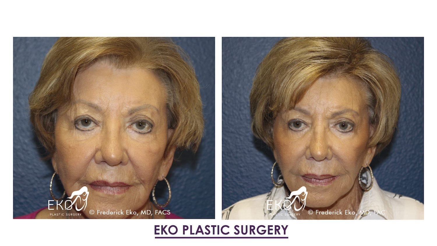 Juvederm Before and After Photo by Dr. Eko of Eko Plastic Surgery in Palm Desert, CA