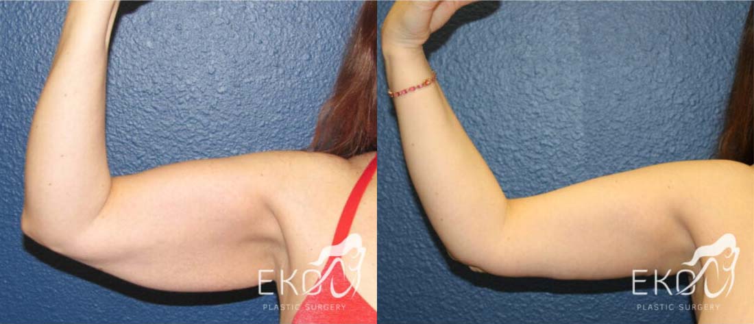 Arm Lift Before and After Photo by Dr. Eko of Eko Plastic Surgery in Palm Desert, CA Arm Lift Before and After Photo by Dr. Eko of Eko Plastic Surgery in Palm Desert, CA