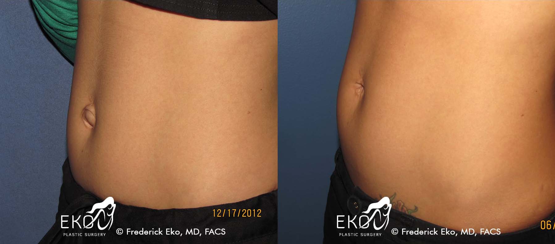 Belly Button Surgery (Umbilicoplasty) Before and After Photo by Dr. Eko of Eko Plastic Surgery in Palm Desert, CA Belly Button Surgery (Umbilicoplasty) Before and After Photo by Dr. Eko of Eko Plastic Surgery in Palm Desert, CA