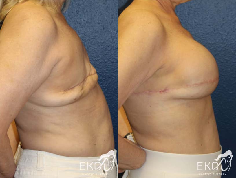 Breast Reconstruction Before and After Photo by Dr. Eko of Eko Plastic Surgery in Palm Desert, CA Breast Reconstruction Before and After Photo by Dr. Eko of Eko Plastic Surgery in Palm Desert, CA