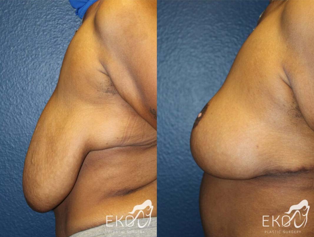 Breast Reduction Before and After Photo by Dr. Eko of Eko Plastic Surgery in Palm Desert, CA