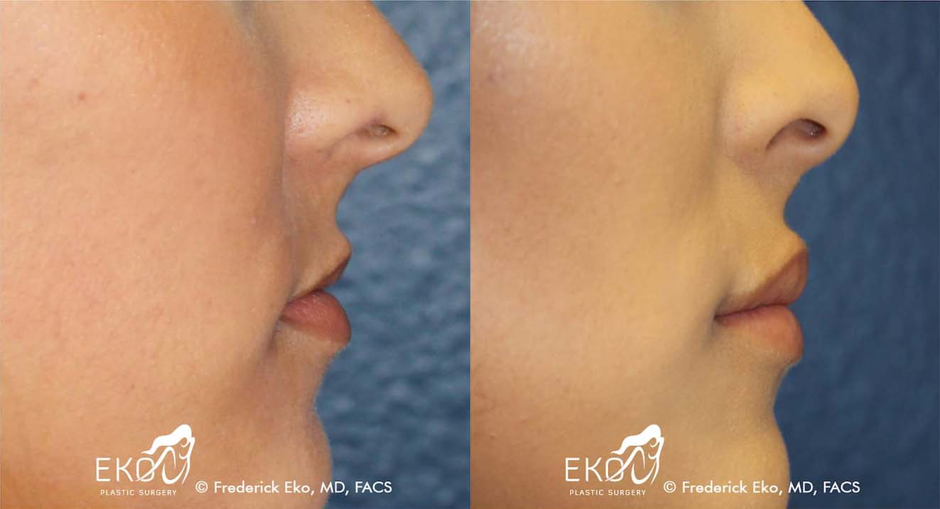 Juvederm Before and After Photo by Dr. Eko of Eko Plastic Surgery in Palm Desert, CA Juvederm Before and After Photo by Dr. Eko of Eko Plastic Surgery in Palm Desert, CA