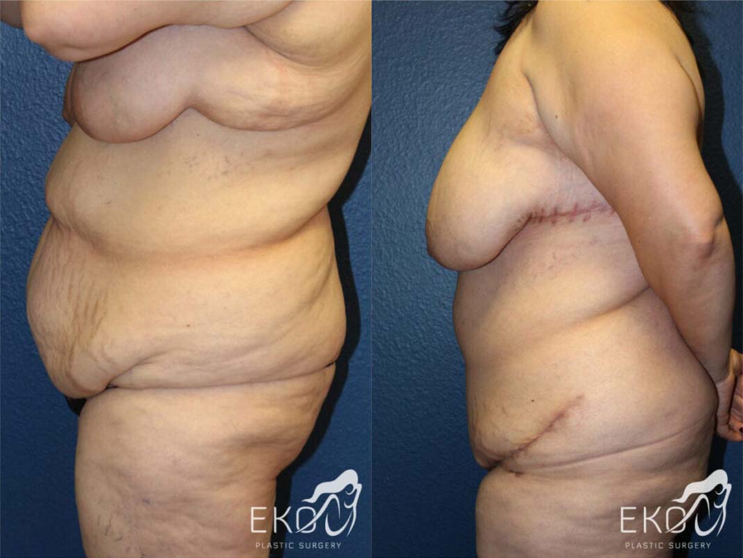 Post Weight Loss Procedures Before and After Photo by Dr. Eko of Eko Plastic Surgery in Palm Desert, CA Post Weight Loss Procedures Before and After Photo by Dr. Eko of Eko Plastic Surgery in Palm Desert, CA