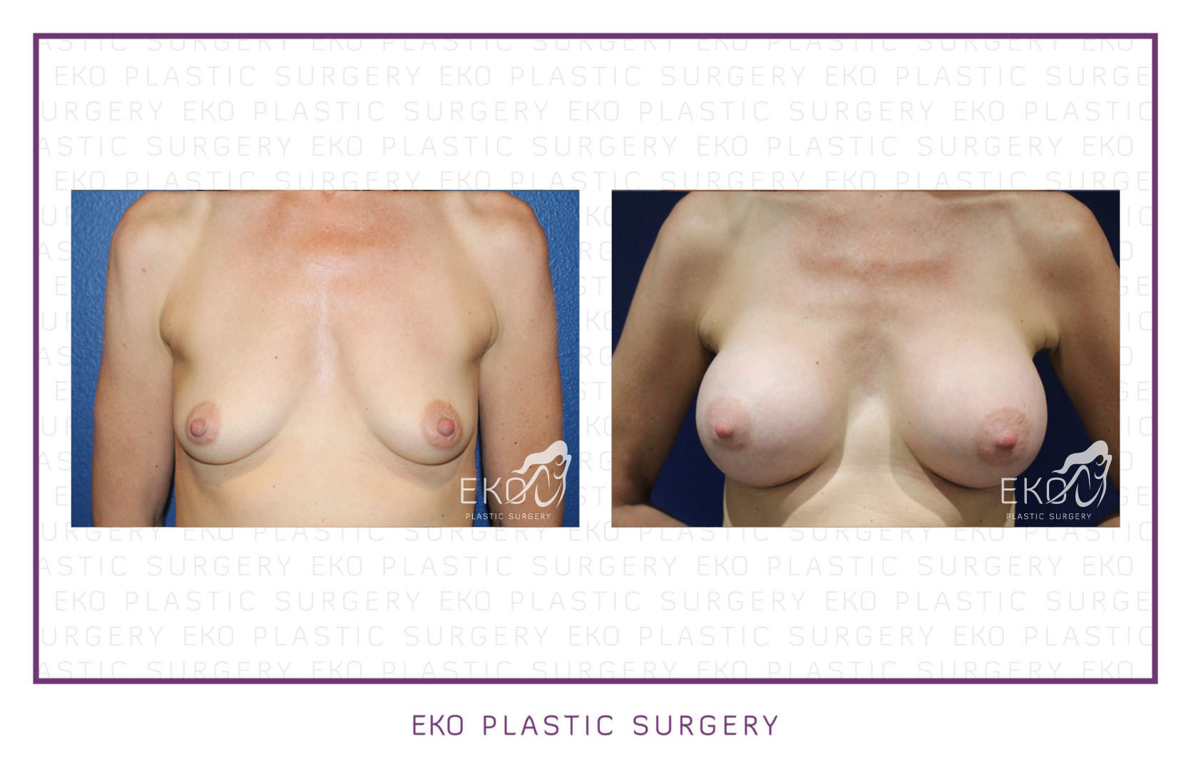 Breast Augmentation Before and After Photo by Dr. Eko of Eko Plastic Surgery in Palm Desert, CA