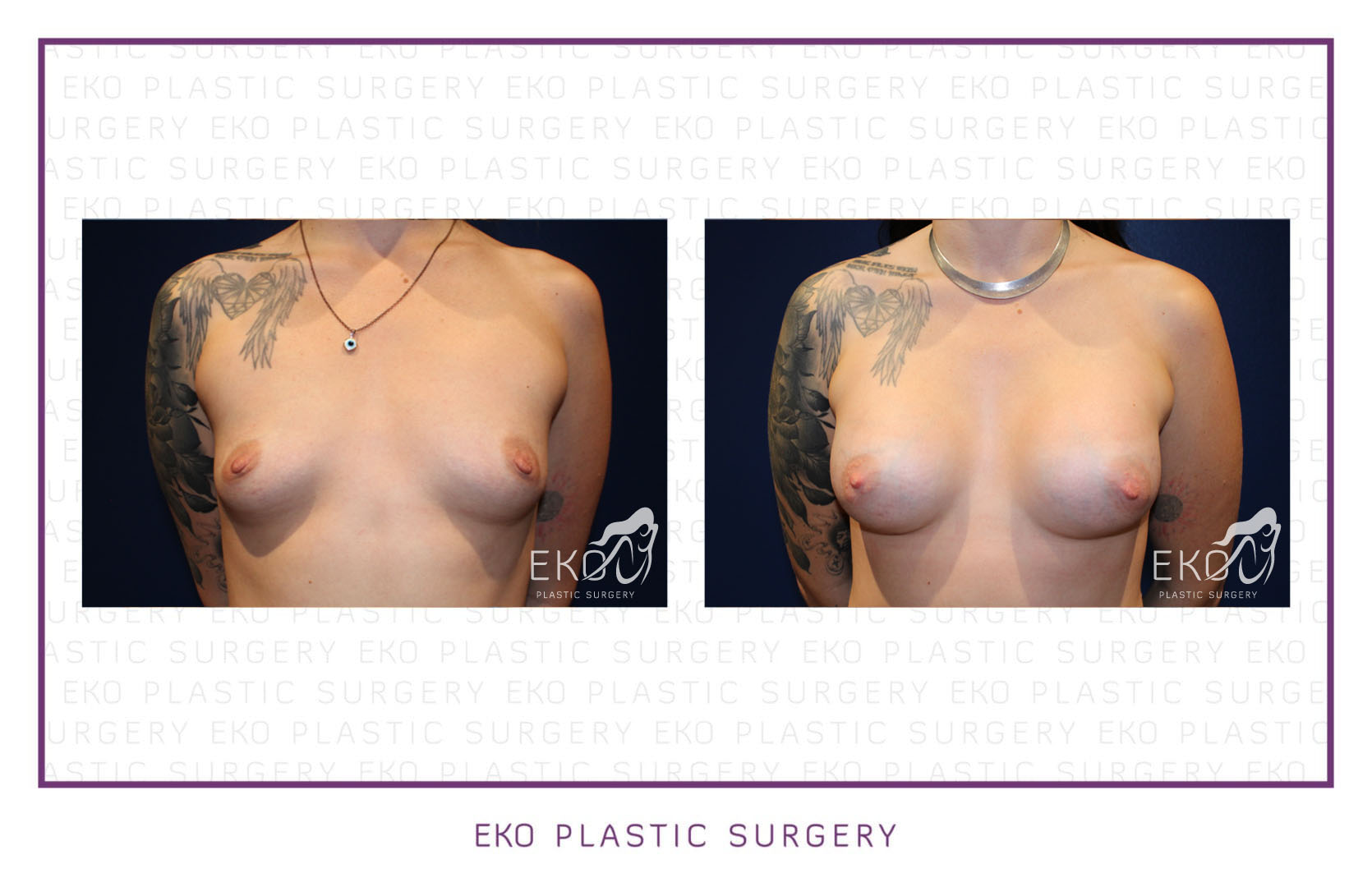 Breast Augmentation Before and After Photo by Dr. Eko of Eko Plastic Surgery in Palm Desert, CA