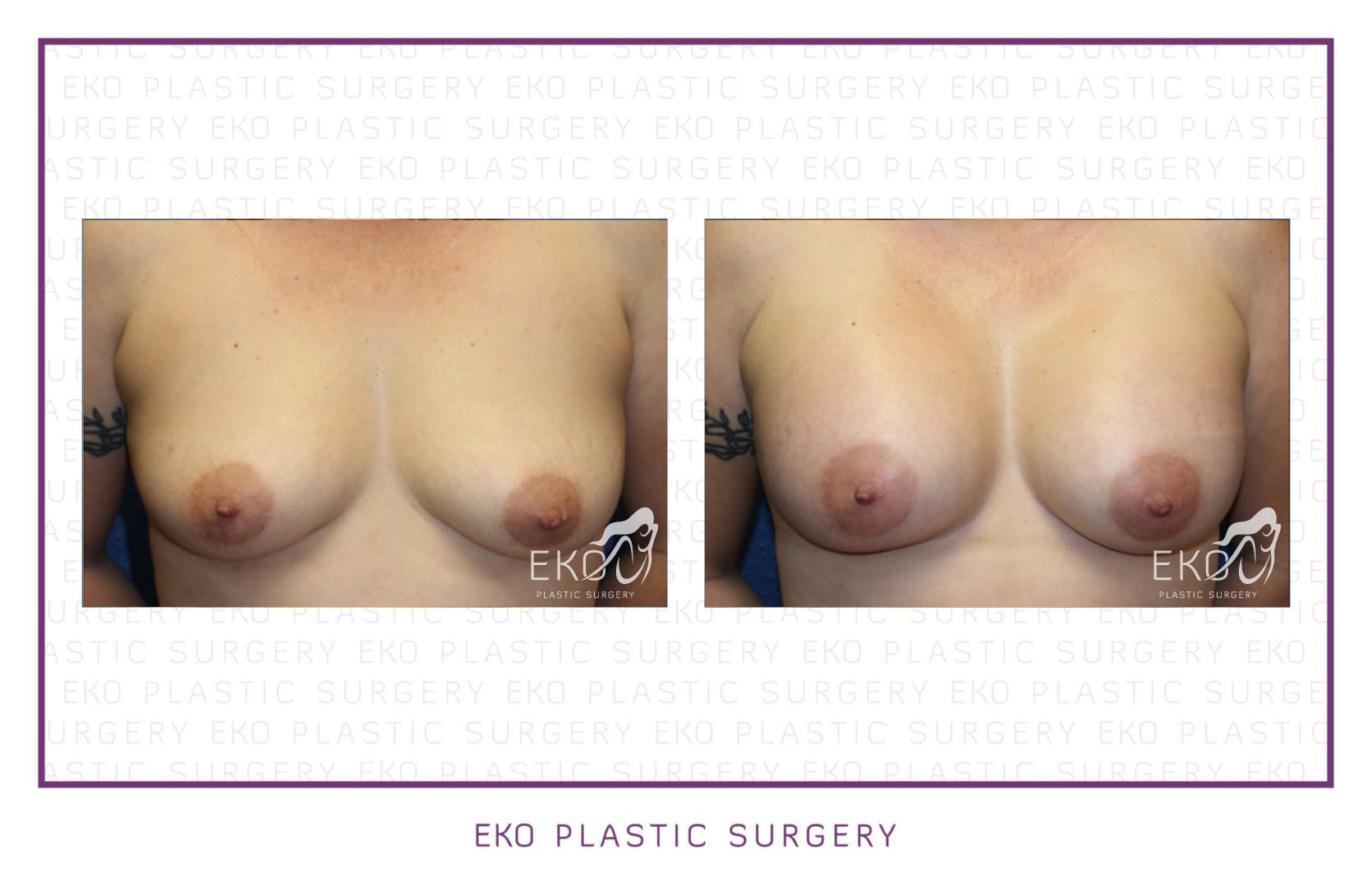 Breast Augmentation Before and After Photo by Dr. Eko of Eko Plastic Surgery in Palm Desert, CA