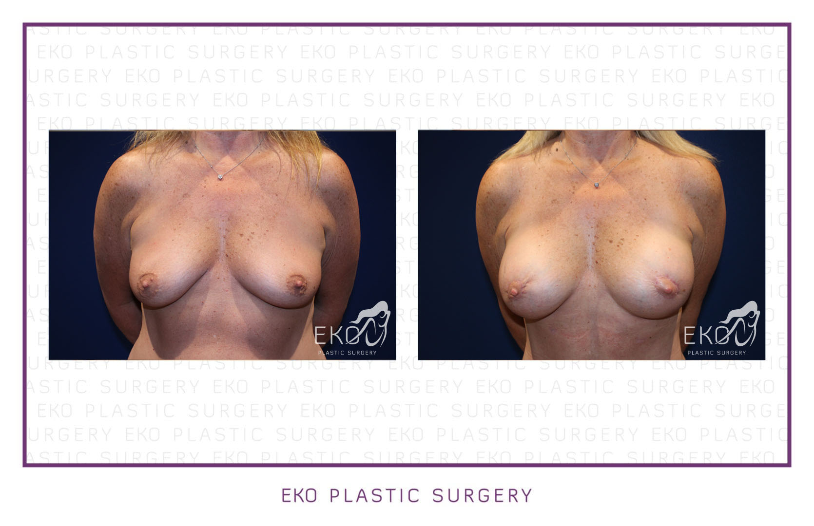 Breast Augmentation Before and After Photo by Dr. Eko of Eko Plastic Surgery in Palm Desert, CA