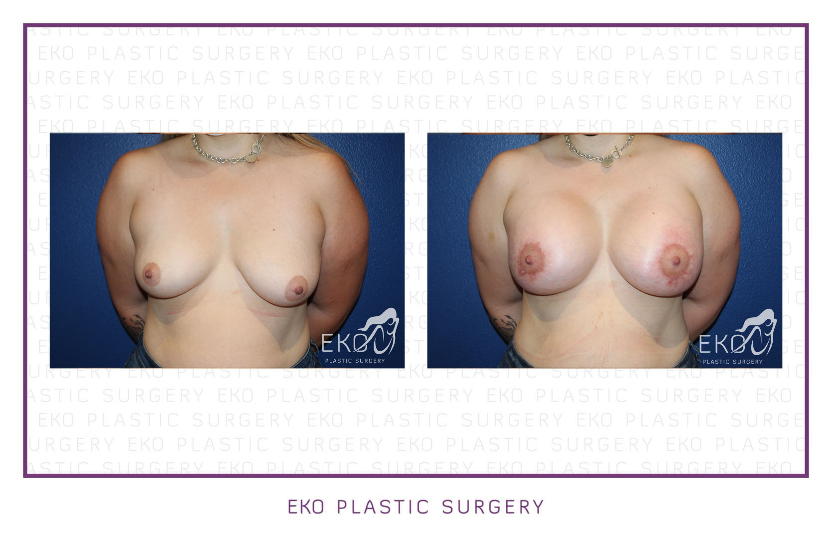 Breast Augmentation Before and After Photo by Dr. Eko of Eko Plastic Surgery in Palm Desert, CA