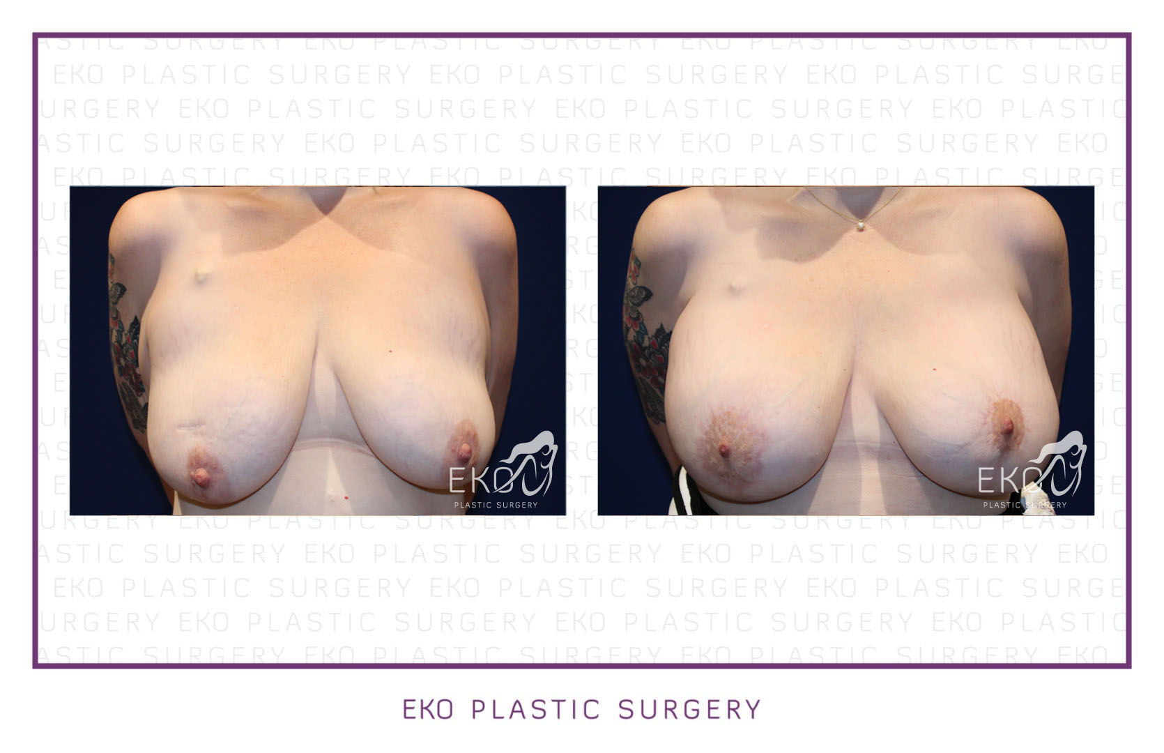 Breast Augmentation Before and After Photo by Dr. Eko of Eko Plastic Surgery in Palm Desert, CA