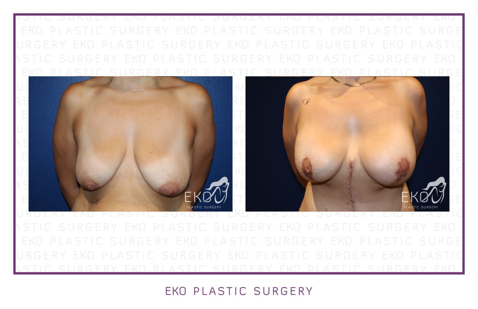 Breast Augmentation Before and After Photo by Dr. Eko of Eko Plastic Surgery in Palm Desert, CA