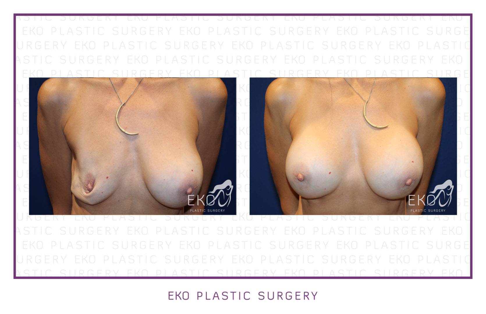 Breast Augmentation Before and After Photo by Dr. Eko of Eko Plastic Surgery in Palm Desert, CA