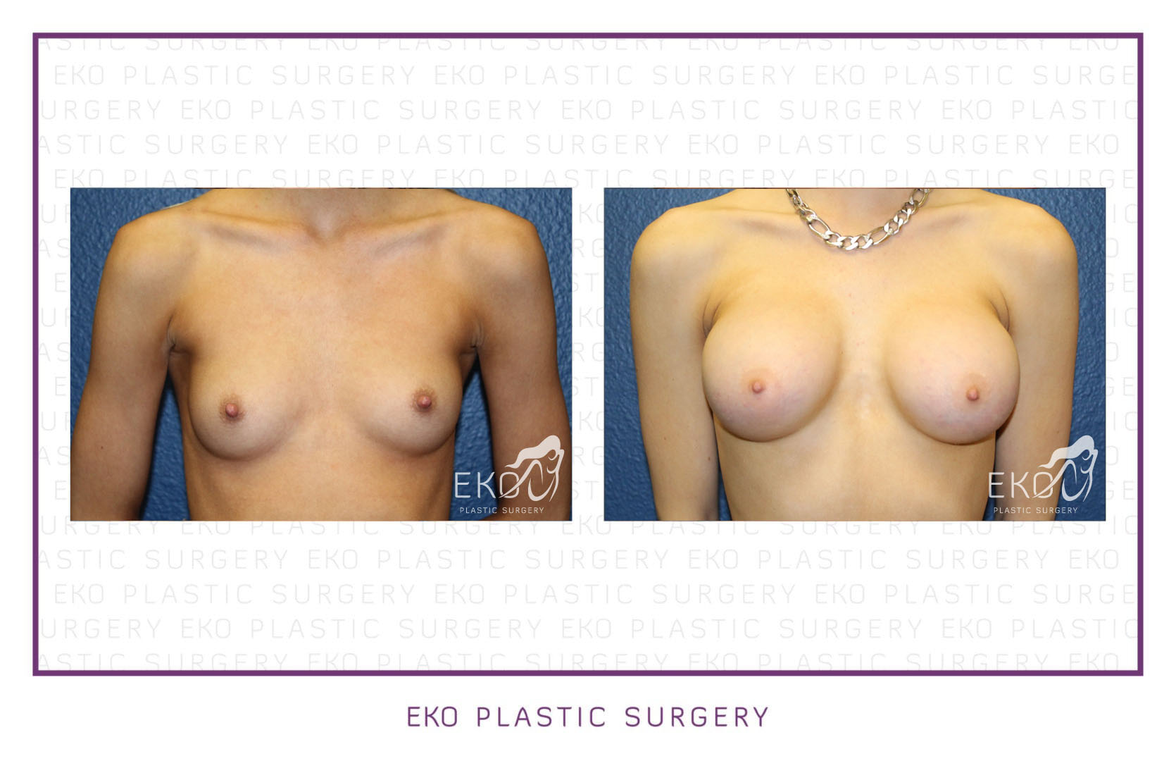 Breast Augmentation Before and After Photo by Dr. Eko of Eko Plastic Surgery in Palm Desert, CA