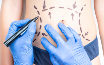 Comparing Liposuction and CoolSculpting®: Which Is Right for You?