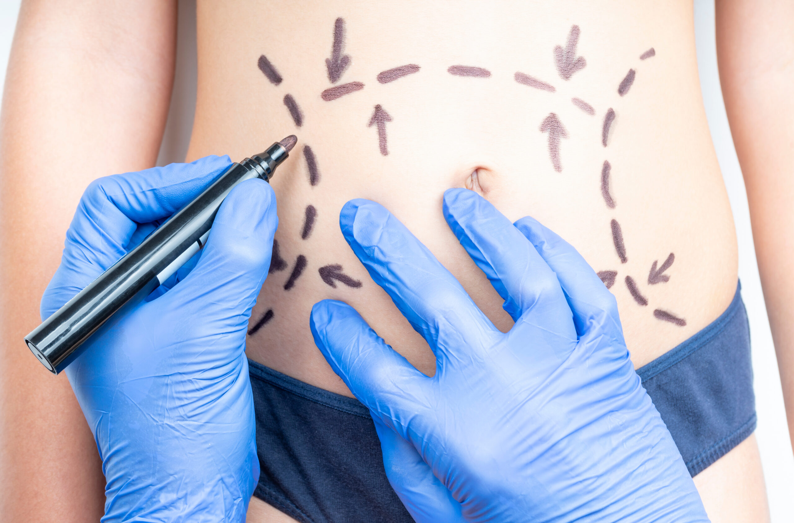 a person undergoing liposuction consultation